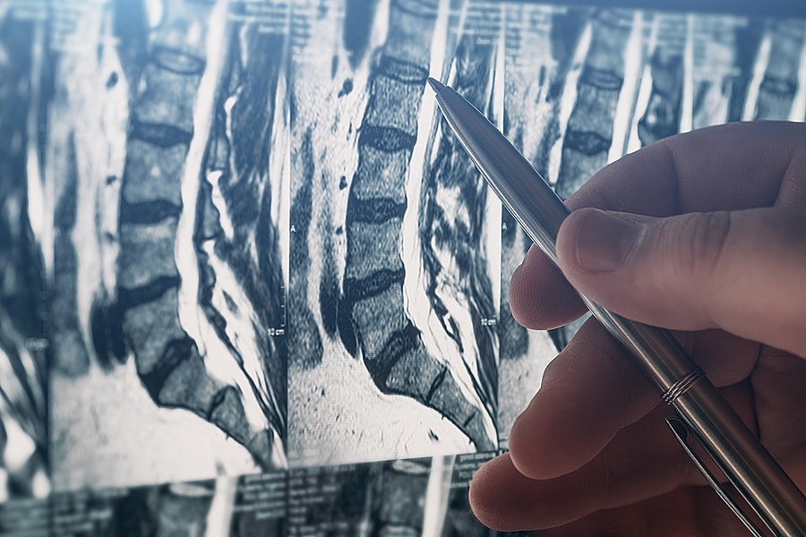 Hand holding pen pointing at spine MRI images.