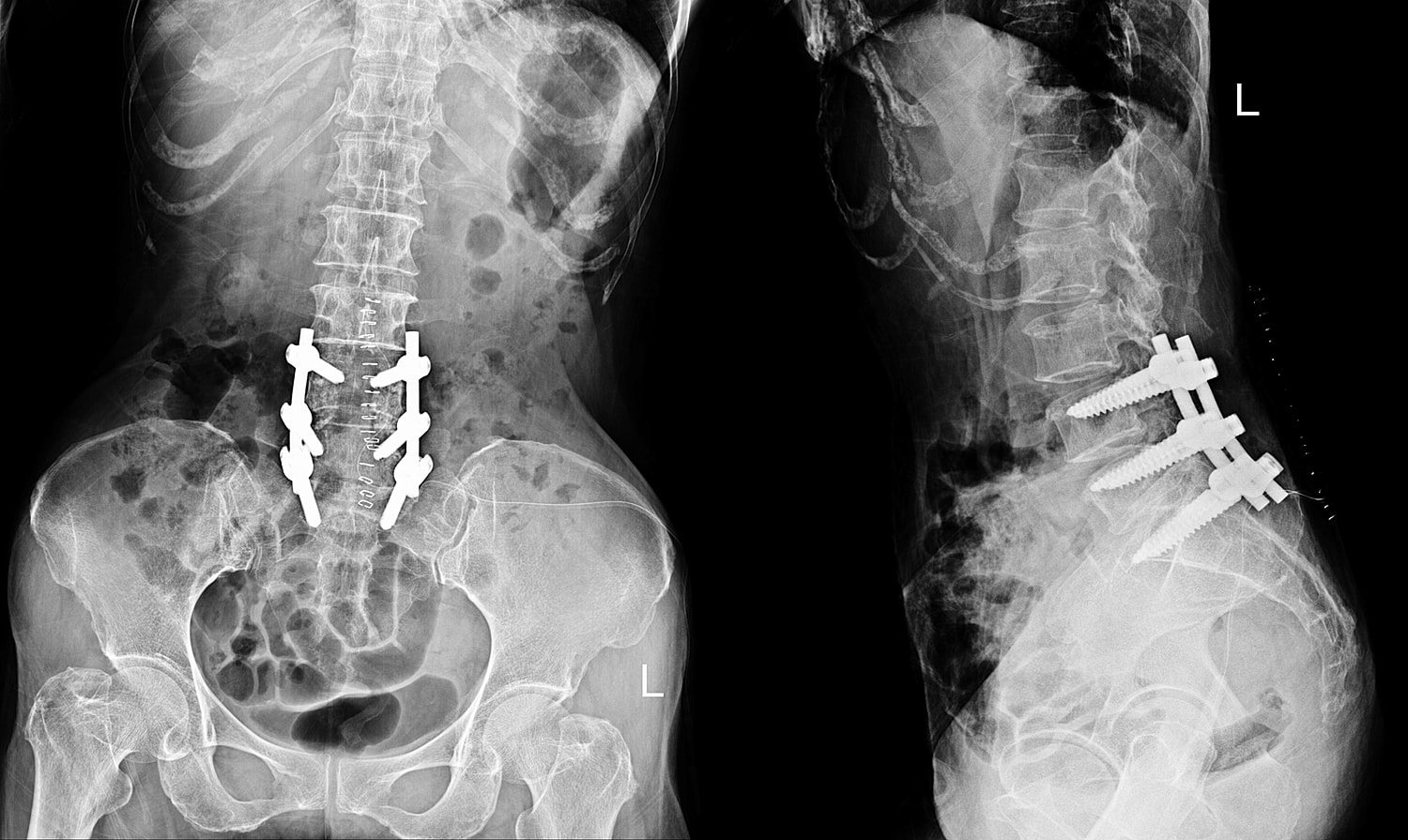 X-ray images of spinal surgery hardware placement.